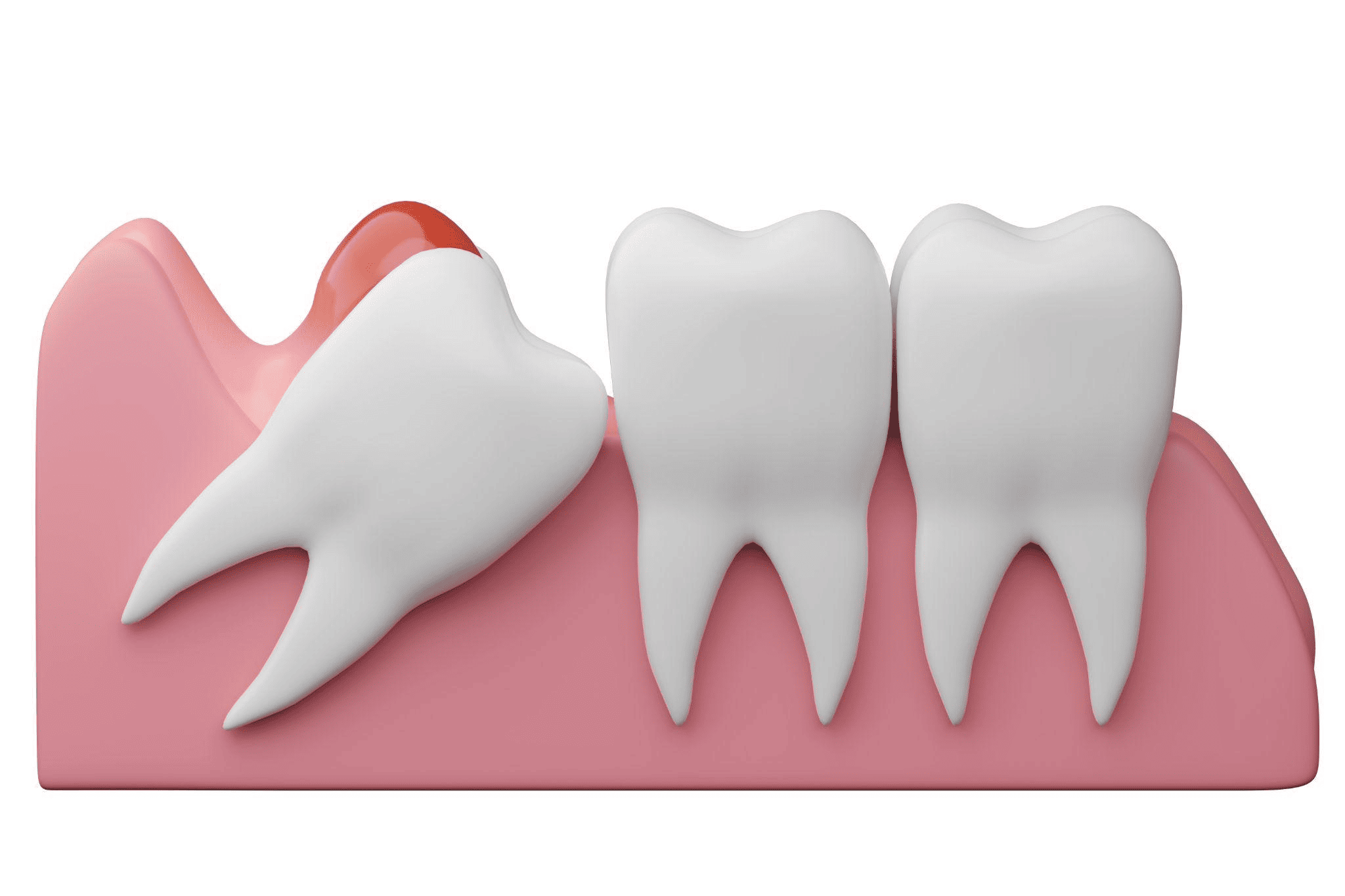 抜歯が難しい親知らずの特徴