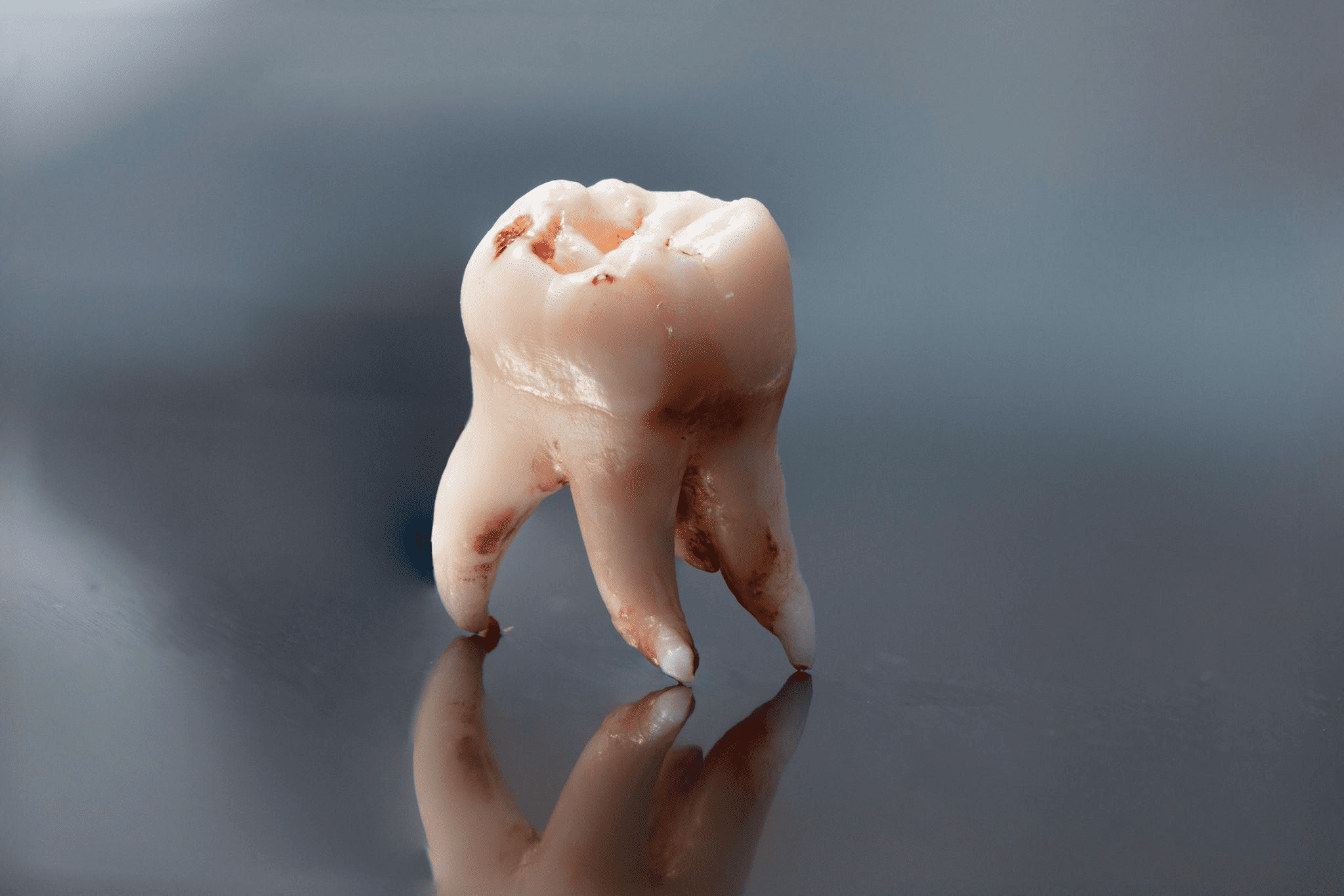 大宮いしはた歯科の親知らず抜歯